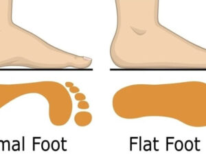 Can Barefoot Shoes Fix Flat Feet?