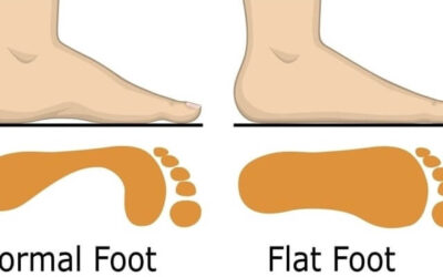 Can Barefoot Shoes Fix Flat Feet?