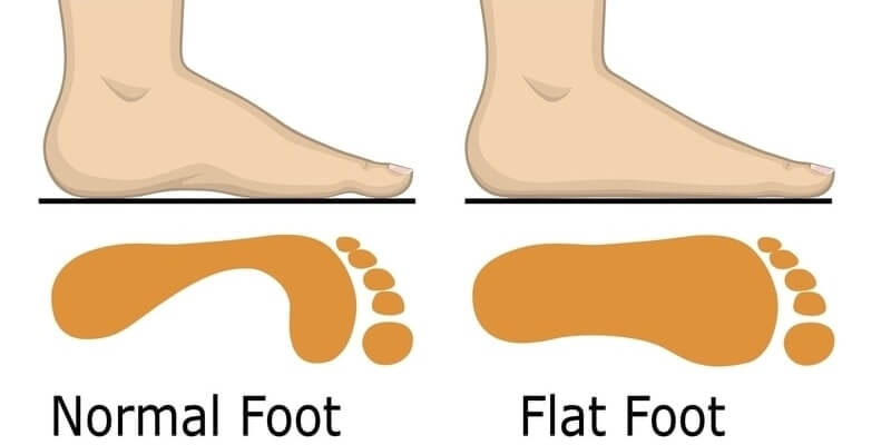 Can Barefoot Shoes Fix Flat Feet?